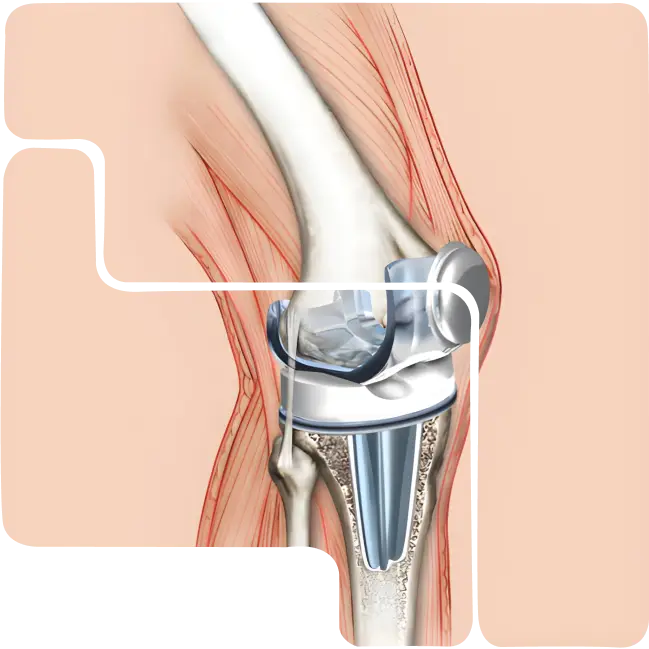 TASC (Multi-Functional) PVD coating for die casting and forging tools offering superior hardness and durability.