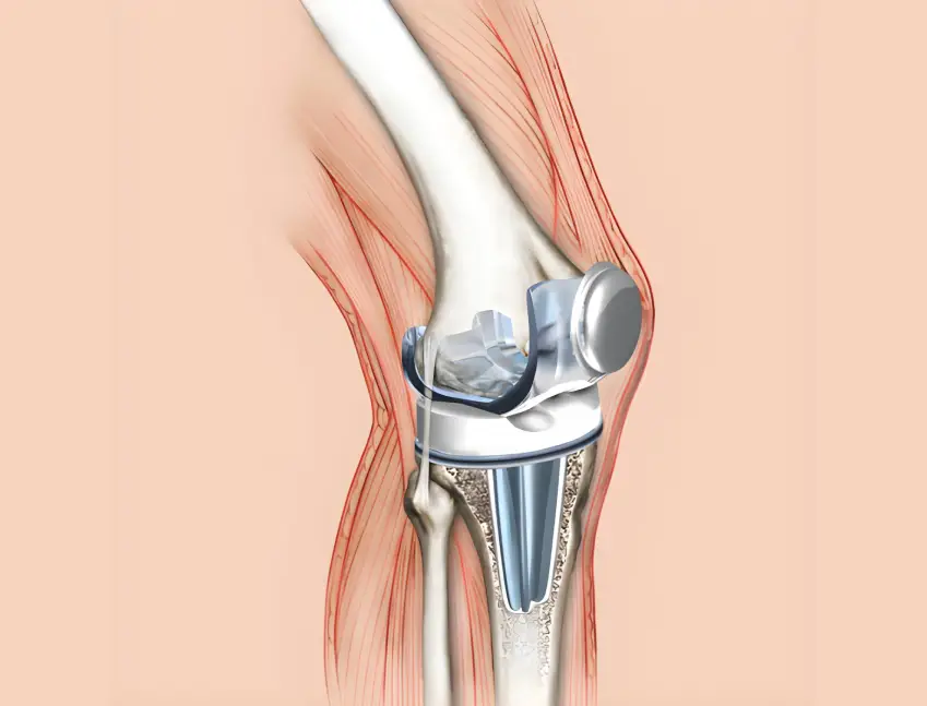 An illustration of a modern knee joint orthopedic implant, representing critical components protected by the TASC PVD Coating, a multi-functional solution to increase long-term durability and productivity.